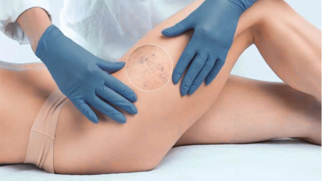 Flat illustration: woman with fine spider veins on the calf and a compact mirror; arrow toward stronger vein lines under a magnifying lens and a doctor examining a patient’s leg, from self-check to clinical assessment.